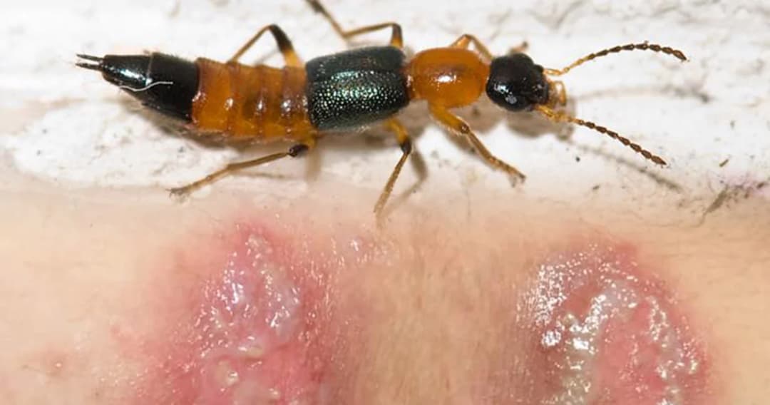 หมอเตือน เจอแมลงก้นกระดก ห้ามตบหรือบี้