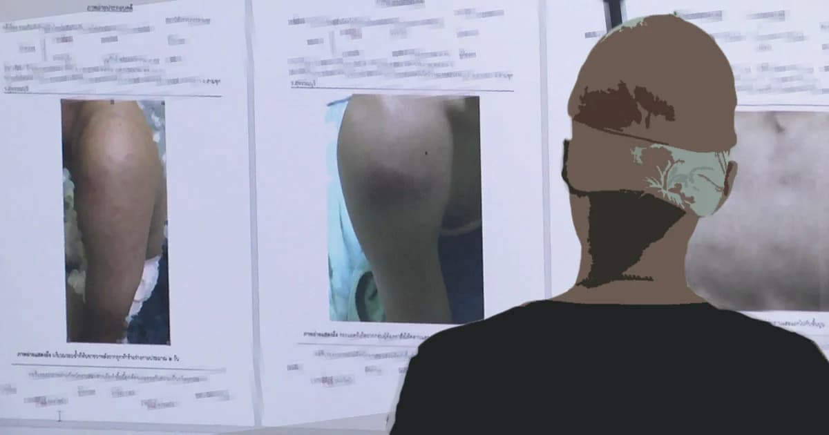 ผู้ปกครองพา นศ.ปี 2 แจ้งดำเนินคดีรุ่นพี่ปี 3 รับน้องโหดจนช้ำไปทั้งตัว