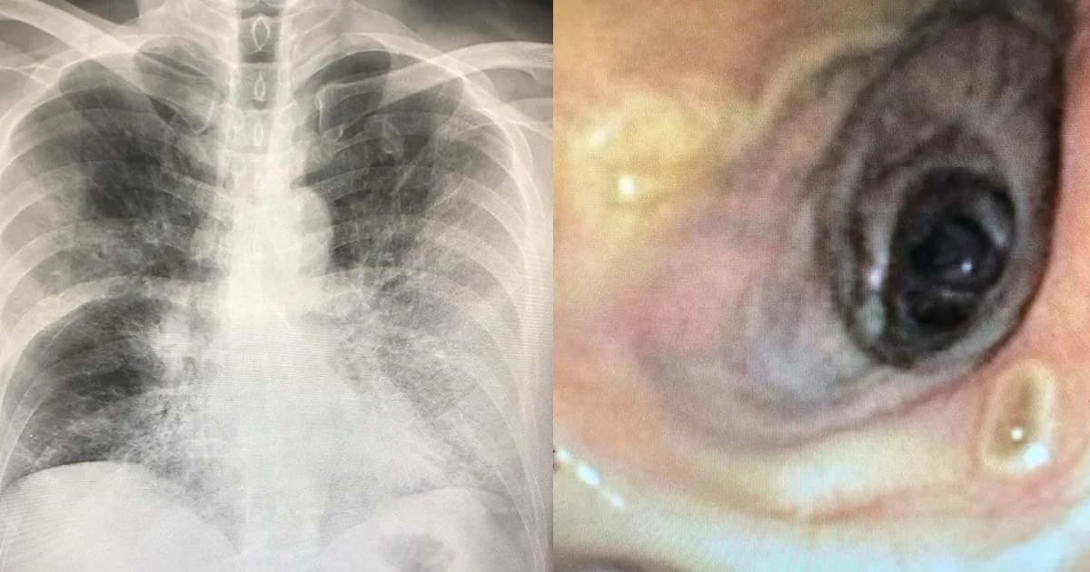 หมอเตือนป่วยไข้หวัดใหญ่ ติดเชื้อราในอากาศลุกลามจนเสียชีวิต