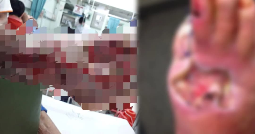 รพ.น่าน เตือนระวังโรคเนื้อเน่า-แบคทีเรียกินเนื้อคน ป่วยแล้ว 25 ราย เข้าไอซียู 1 ราย