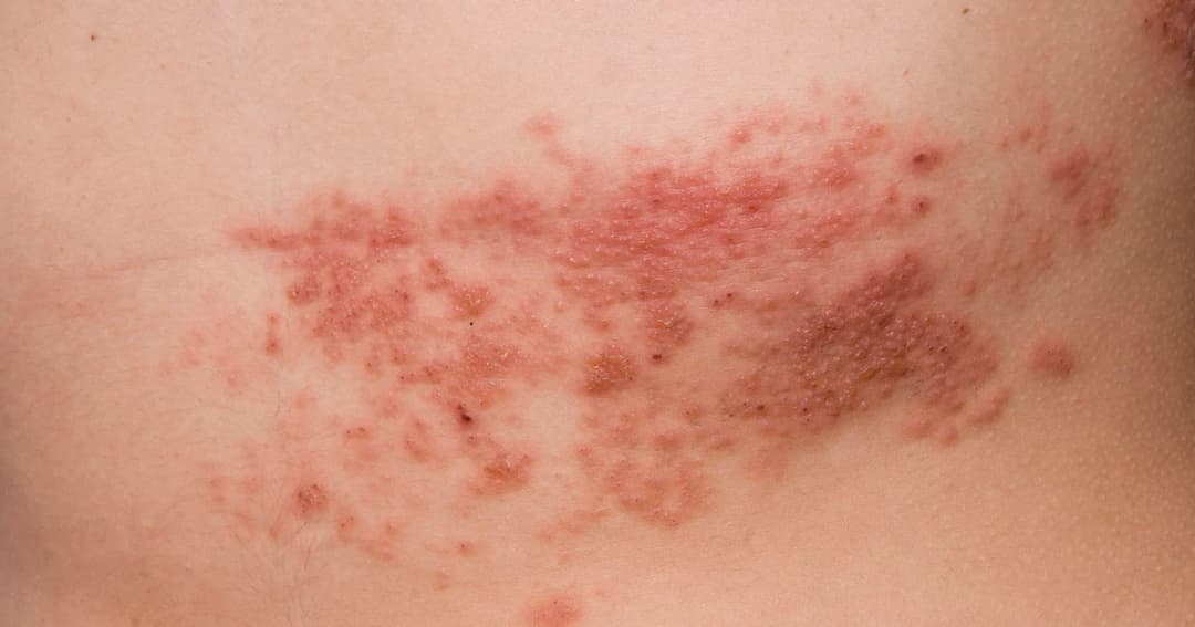 แพทย์แนะฉีดวัคซีนป้องกัน ‘โรคงูสวัด’ ในผู้สูงอายุ