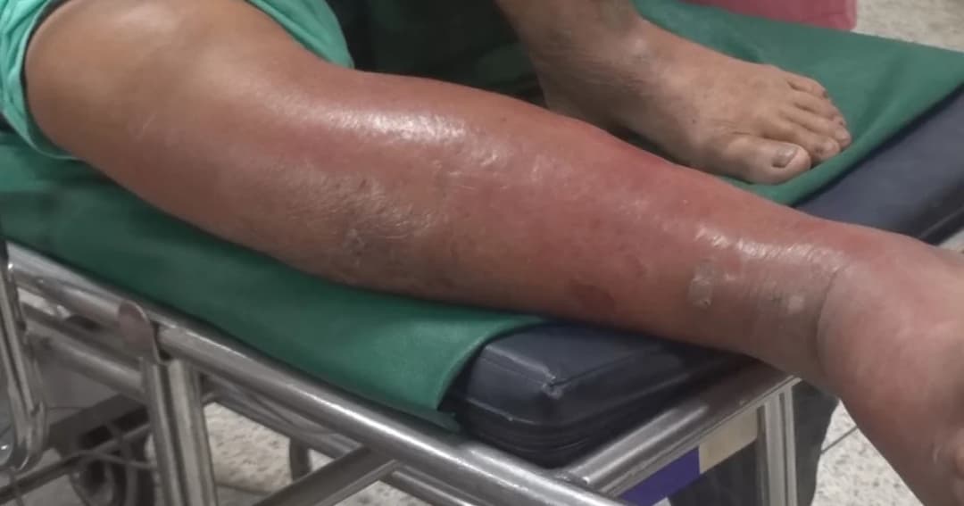 โรคเนื้อเน่า-แบคทีเรียกินเนื้อคนระบาดหนักทั่ว จ.น่าน เสียชีวิตแล้ว 1 ป่วยอีก 26 ราย