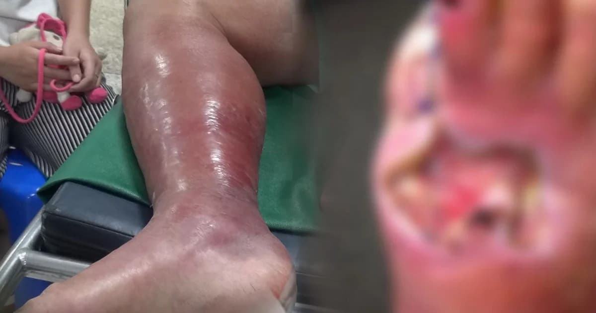 รู้จักสาเหตุและวิธีป้องกัน “โรคเนื้อเน่า-แบคทีเรียกินเนื้อคน” อันตรายถึงแก่ชีวิต