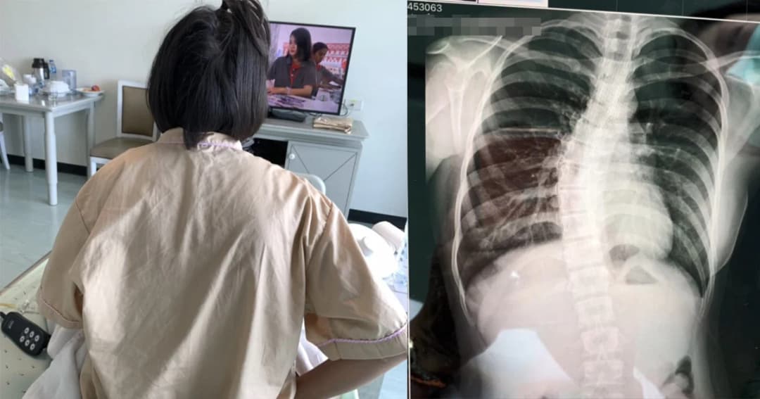 กระดูกสันหลังลูกสาววัย 14 คดงอ คาด เหตุจากกระเป๋านักเรียนหนัก