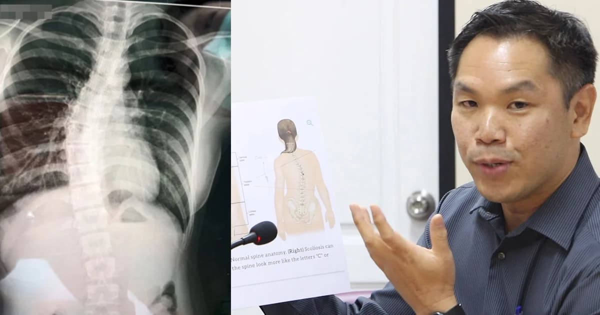 กระเป๋าหนักไม่เกี่ยวกระดูกหลังคด แต่เด็กหญิงมีความเสี่ยง 2 ใน 100 คน