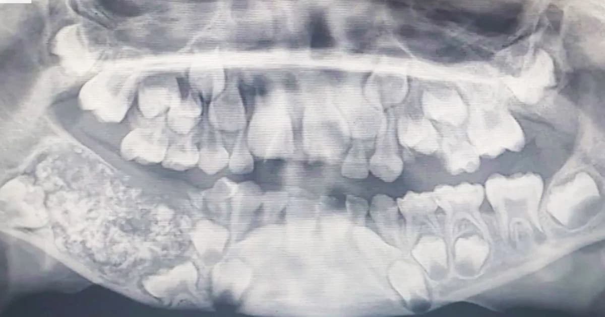 เคสแรกในโลก! ด.ช.ชาวอินเดียวัย 7 ขวบมีฟันมากถึง 526 ซี่