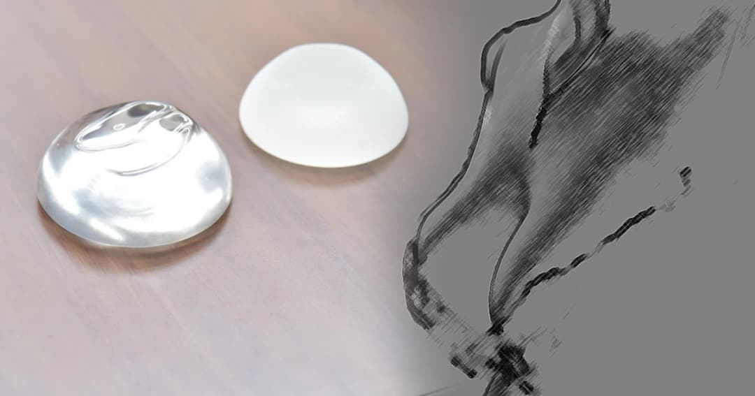 เรียกคืนเต้านมเทียมซิลิโคนชนิดผิวขรุขระ “นาเทรล” เสี่ยงมะเร็งต่อมน้ำเหลือง