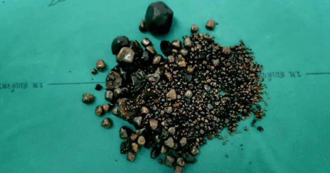 เปิดสถิติใหม่! แพทย์ รพ.สมเด็จพระยุพราชท่าบ่อผ่าตัดนิ่ว 1,898 เม็ดในถุงน้ำดี