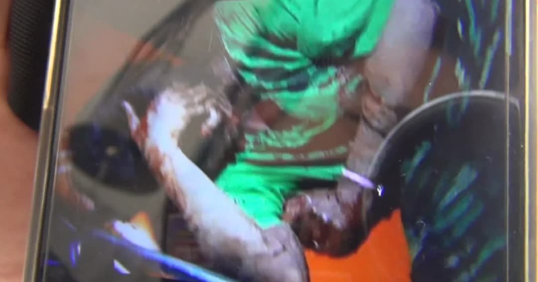 มอบตัวแล้วหนุ่มหึงโหด น้ำมันราดเผาแฟนทั้งเป็น