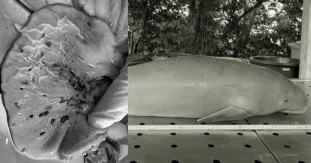 ผลชันสูตร “ยามีล” กล้ามเนื้อหัวใจขาดเลือด-ช็อกจากพิษติดเชื้อแทรกซ้อนลามทั่วตัว