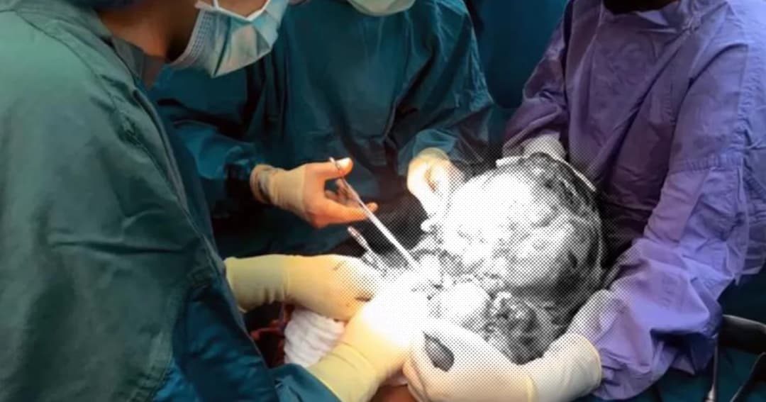 แพทย์ตะลึง! พบก้อนเนื้อหนัก 5.4 กก. ในช่องท้องผู้ป่วยชาย