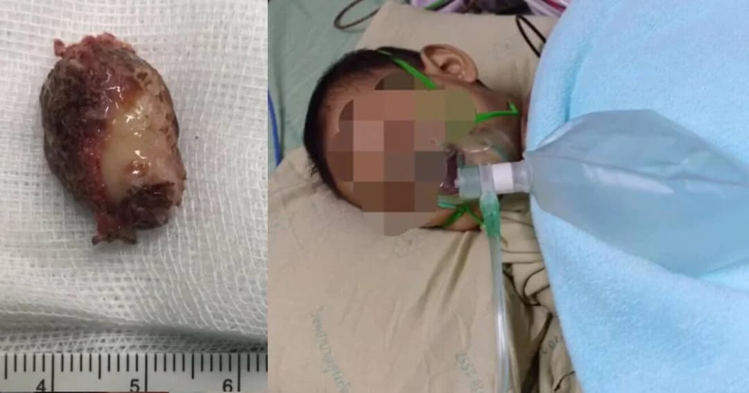 หมอเตือนระวัง หลังพบเด็กเล็ก 1-3 ขวบสิ่งของติดคอมากขึ้น