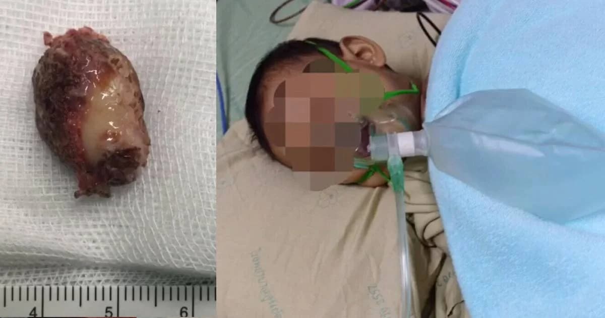 หมอเตือนระวัง หลังพบเด็กเล็ก 1-3 ขวบสิ่งของติดคอมากขึ้น