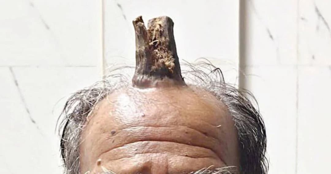 แพทย์ “อินเดีย” ผ่าตัดชายมีเขางอกบนหัวมา 5 ปี