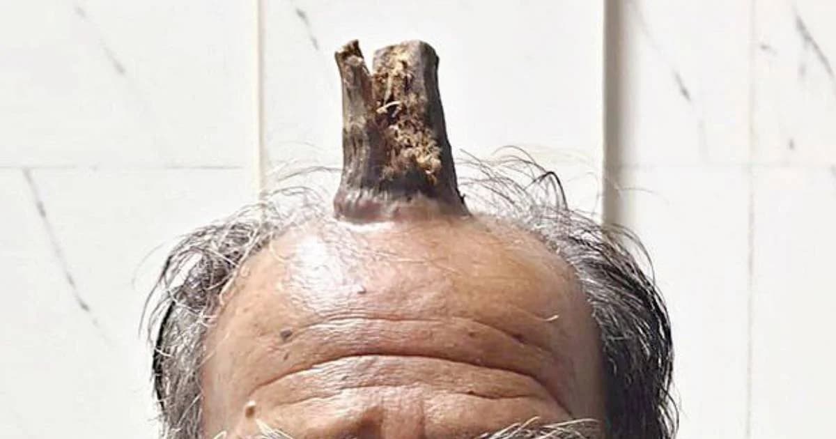 แพทย์ “อินเดีย” ผ่าตัดชายมีเขางอกบนหัวมา 5 ปี