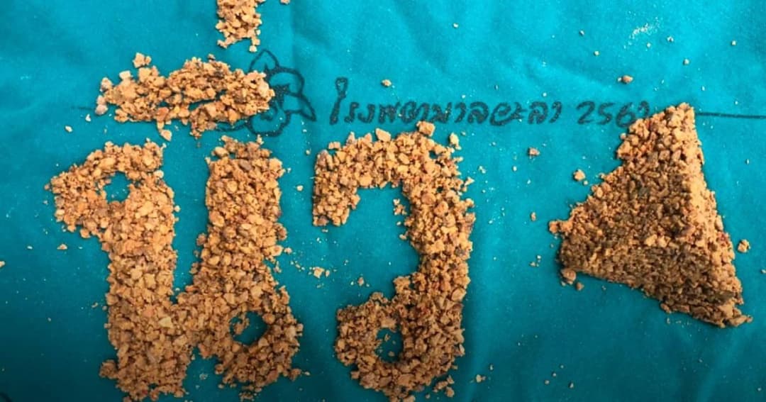 แพทย์ยะลาเผยภาพนิ่วในไตคนไข้ แนะต้องดื่มน้ำให้เพียงพอ