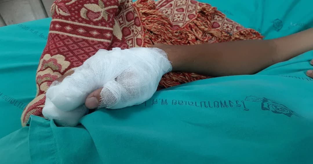 นร.ชายจุดประทัดเล่นระเบิดใส่มือ นิ้วขาด!