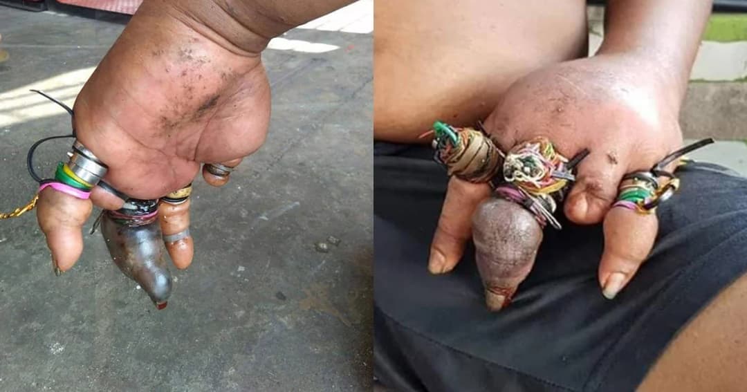 เจ็บปวด! หนุ่มสติไม่ดีใส่แหวนและใช้หนังยางมัดนิ้วจนเลือดไม่เดิน