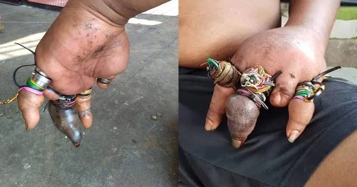เจ็บปวด! หนุ่มสติไม่ดีใส่แหวนและใช้หนังยางมัดนิ้วจนเลือดไม่เดิน