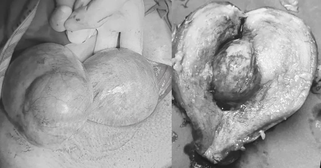 ผงะ! สาวผ่าเนื้องอกในมดลูก-รังไข่พบ ฟัน-ผม-เล็บ