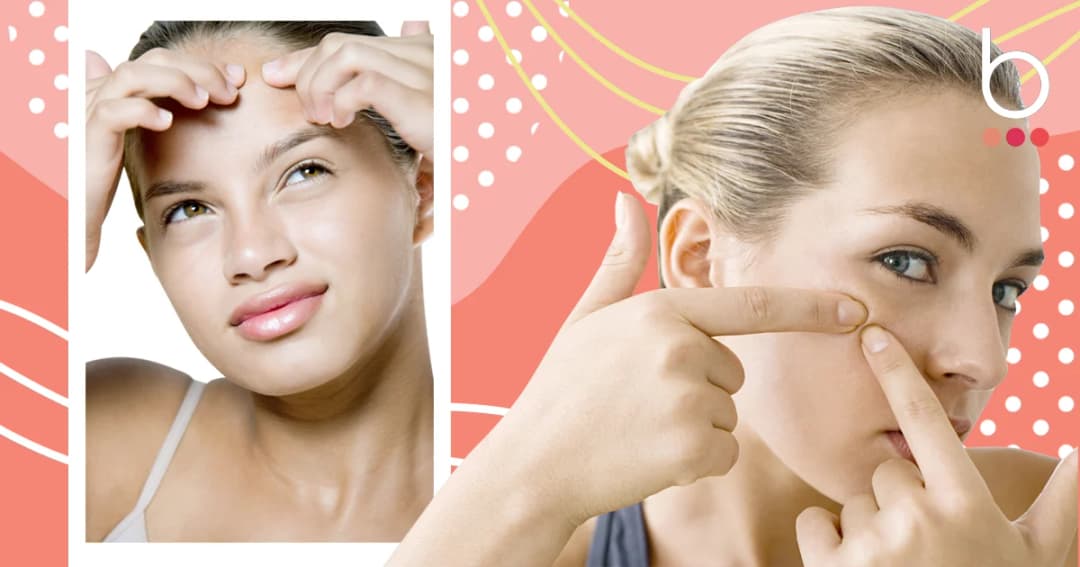 “สิวฮอร์โมน” ไม่ได้เป็นแค่ในเด็กวัยรุ่น