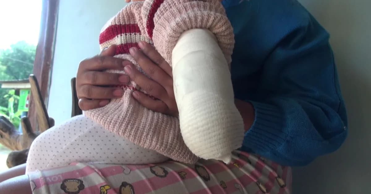 อุทาหรณ์พ่อแม่! ลูกโป่งการ์ตูนระเบิดลูกวัย 8 เดือนถูกไฟไหม้แขนบาดเจ็บ