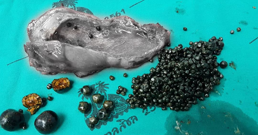 รพ.สิชลใช้แขนกลหุ่นยนต์ช่วยผ่าตัดนิ่วในถุงน้ำดี ผู้ป่วยอายุ 35 ปี พบนิ่ว 861 เม็ด