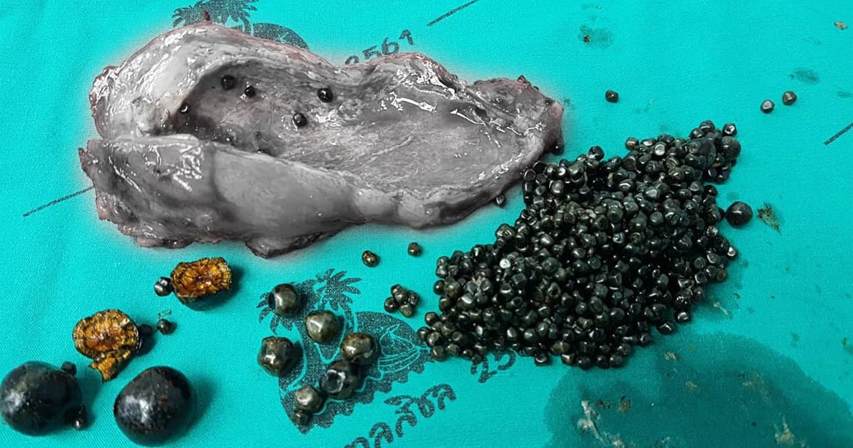 รพ.สิชลใช้แขนกลหุ่นยนต์ช่วยผ่าตัดนิ่วในถุงน้ำดี ผู้ป่วยอายุ 35 ปี พบนิ่ว 861 เม็ด