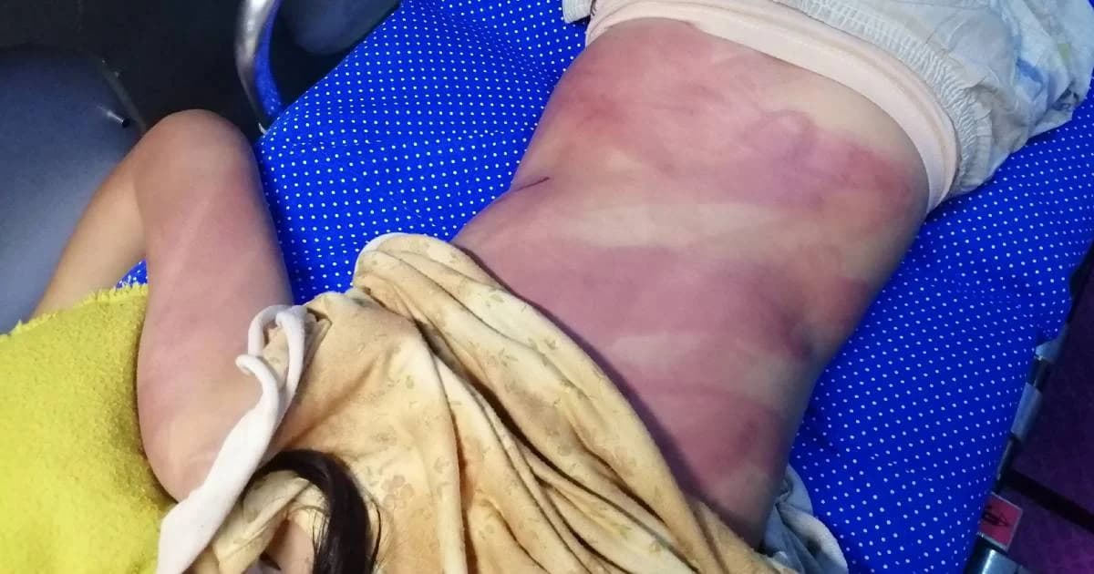 ด.ญ.วัย 10 ขวบ โร่ขอความช่วยเหลือ หลังถูกแม่ตีแดงทั้งตัว เหตุขโมยเงิน