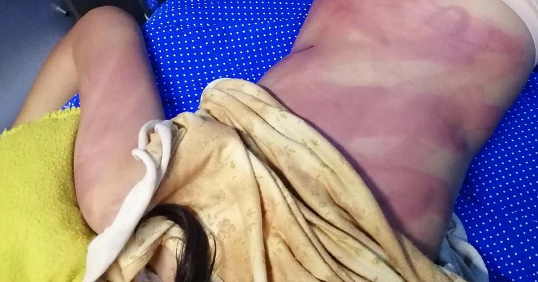 แม่ฟาดลูกวัย 10 ขวบไม่ยั้ง อ้างเด็กขโมยเงิน-ชอบหนีออกจากบ้าน