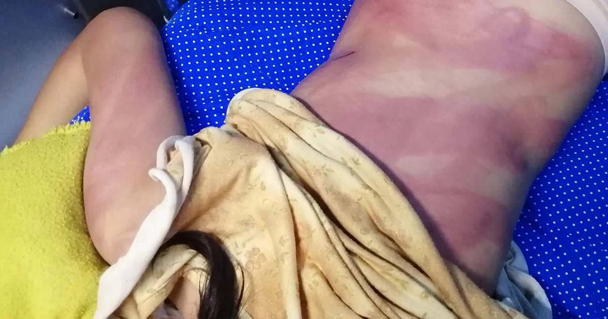 แม่ฟาดลูกวัย 10 ขวบไม่ยั้ง อ้างเด็กขโมยเงิน-ชอบหนีออกจากบ้าน