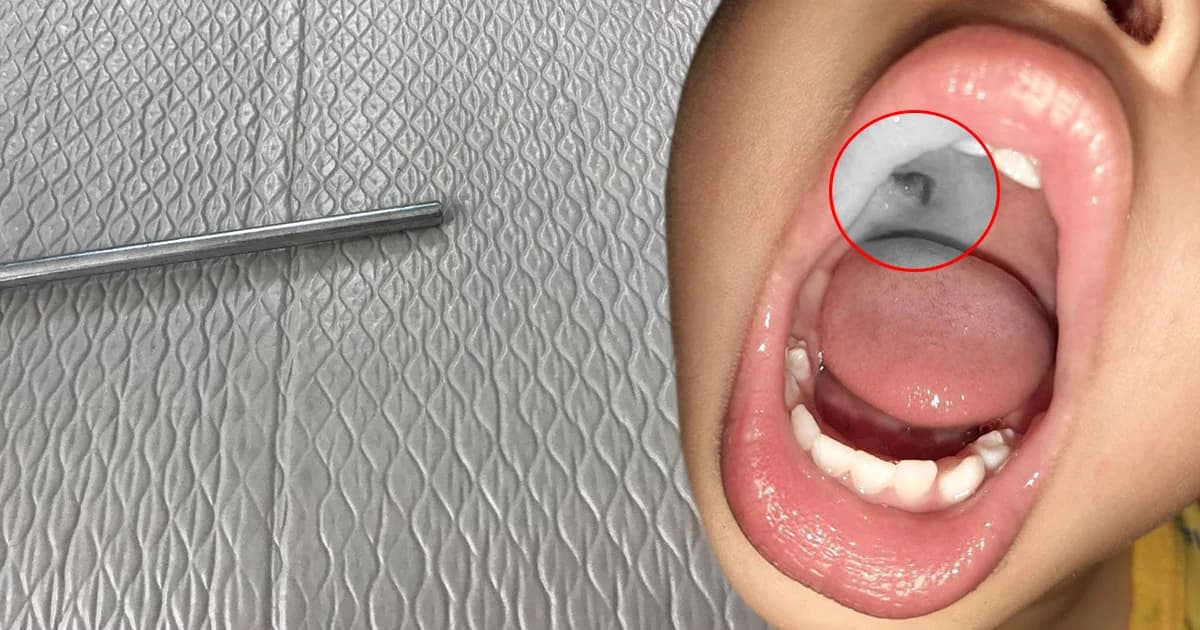 เบ๊น อาปาเช่ โพสต์เตือนภัย! ลูกชายถูกหลอดโลหะแทงปากบาดเจ็บ