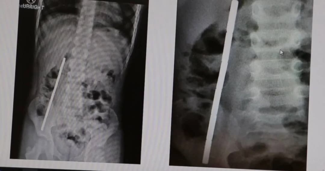 ของเล่นแม่เหล็กค้างในท้องเด็ก 6 ขวบนานเป็นเดือน กว่าพ่อจะผิดสังเกตพาพบหมอ