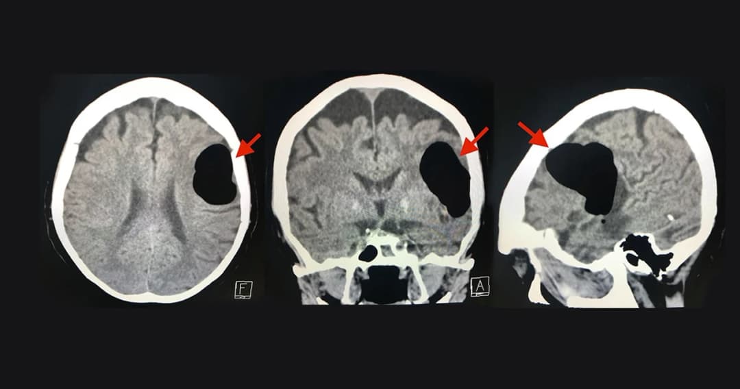 แพทย์เตือนปิดจมูก-ปาก ขณะไอ-จามระวัง ลมตีกลับขึ้นสมอง เสี่ยงอันตราย