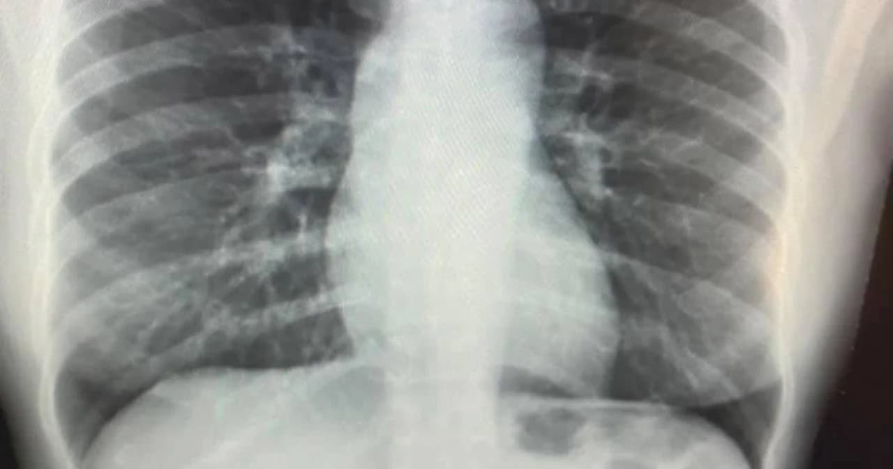 แพทย์แชร์ประสบการณ์ตรง ฉีดซิโนแวค-ติดโควิด-ภูมิคุมกันลดกว่า 30%