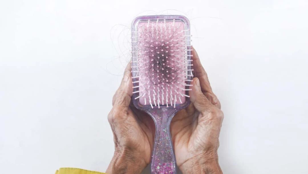 ผมร่วงหมดหัว! หนุ่มวัย 19 ปีเชื่อเป็นอาการแพ้วัคซีน แพทย์ชี้ ‘ภาวะผมร่วง’ เกิดขึ้นได้หลังติดโควิด