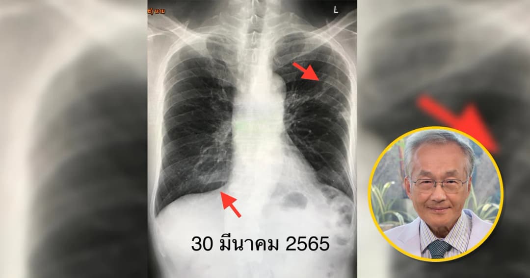 หมอมนูญ เผยพบผู้ติดเชื้อโควิด ป่วยวัณโรค ในเวลาเดียวกัน พร้อมเปิดแนวทางการรักษา