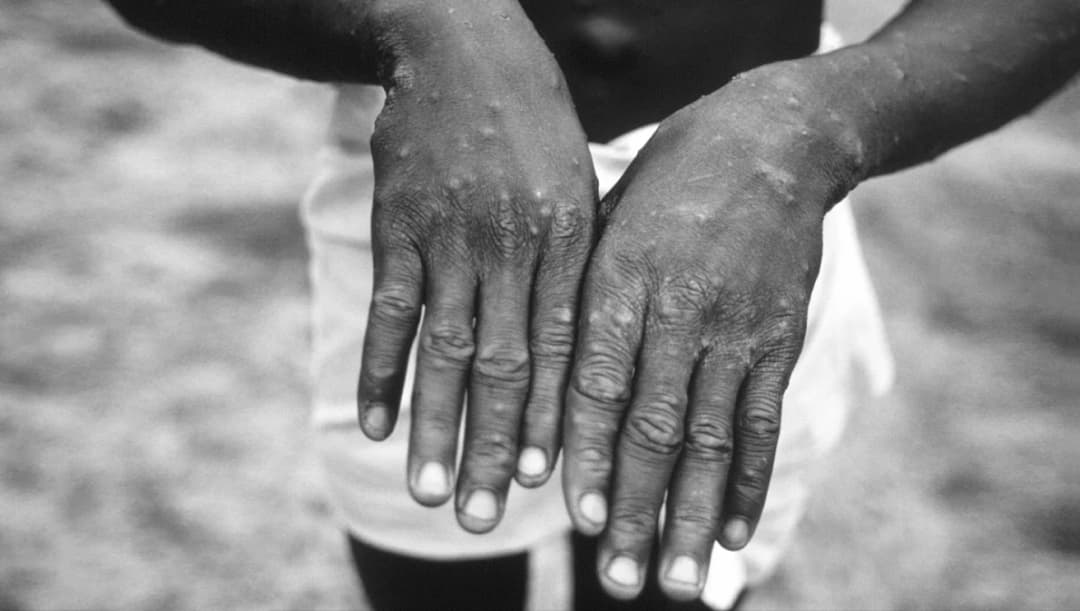 ด่วน! ไทยตั้งศูนย์ฉุกเฉินฯ สกัด ‘ฝีดาษลิง’ จาก 3 ประเทศ