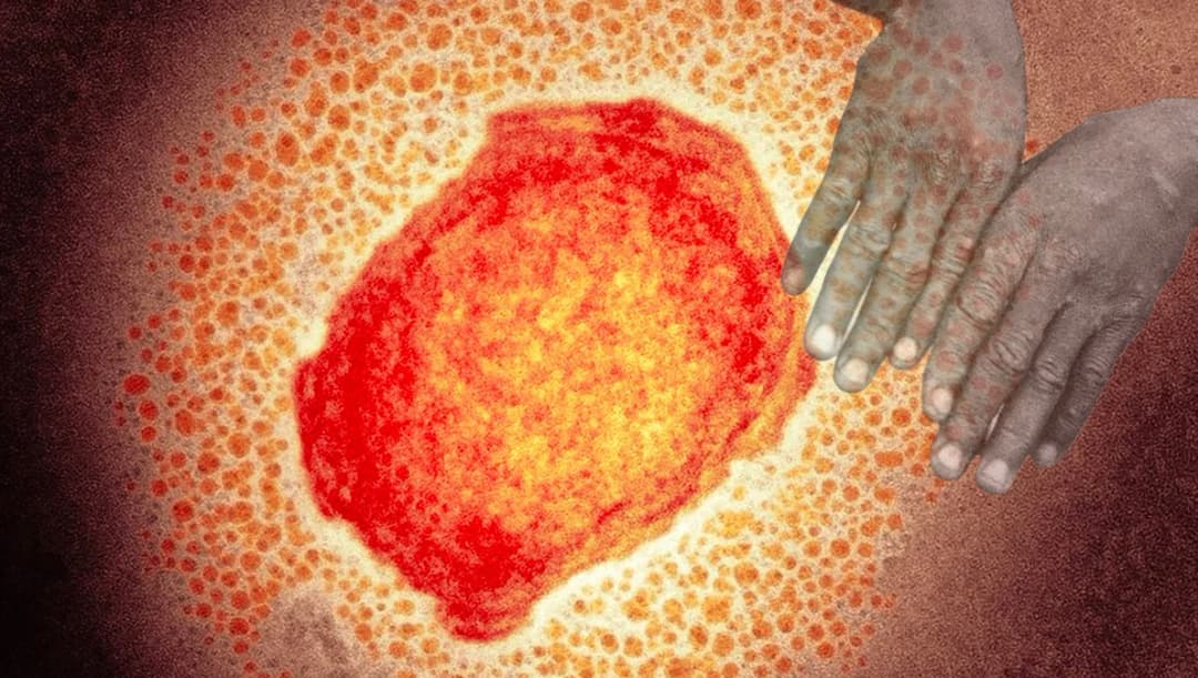 ศูนย์จีโนมฯ คาดใช้เวลา 2 สัปดาห์ถอดรหัสพันธุกรรม ‘ฝีดาษลิง’ พัฒนาชุดตรวจคัดกรอง