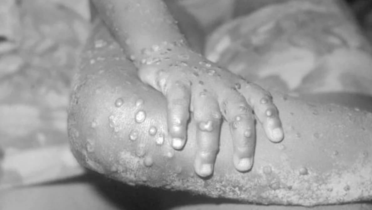 อัปเดตสถานการณ์ ‘โรคฝีดาษลิง’ ยังไม่พบในไทย แต่ไม่ประมาททั่วโลกป่วย 22 ประเทศ