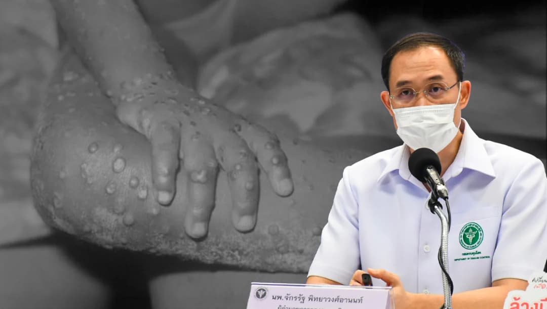 กำหนดให้ ‘โรคฝีดาษลิง’ เป็นโรคติดต่อเฝ้าระวัง