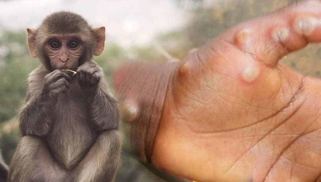 องค์กรวิชาชีพทางการแพทย์ร่วมกันลงนามประกาศ 9 ข้อ ‘โรคฝีดาษลิง’