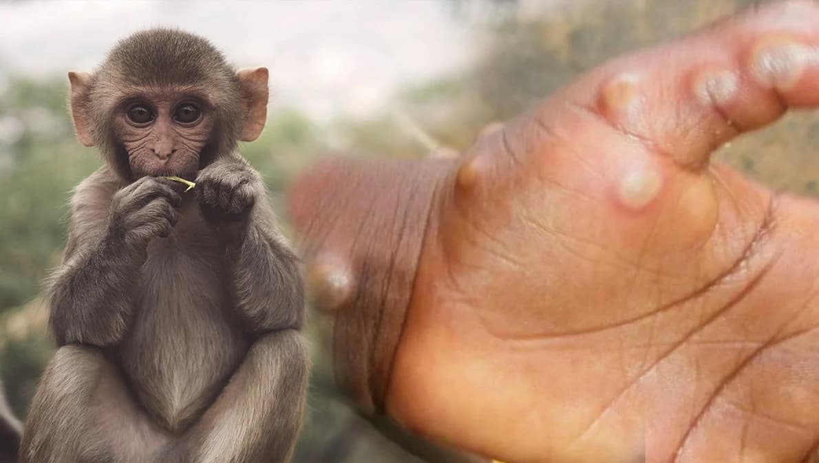 องค์กรวิชาชีพทางการแพทย์ร่วมกันลงนามประกาศ 9 ข้อ ‘โรคฝีดาษลิง’