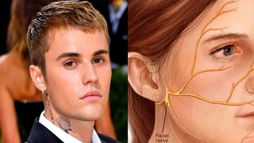  ‘อัมพาตหน้าครึ่งซีก’ โรคใกล้ตัวพบได้ทุกช่วงอายุ เป็นแล้วต้องรีบพบแพทย์