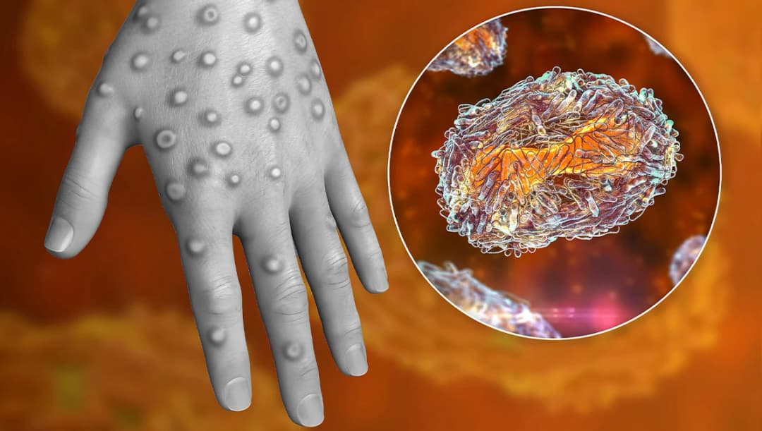 สธ.ย้ำฝีดาษลิงติดยากกว่าโควิด-19 เผยผลตรวจผู้ต้องสงสัย 10 ราย เป็นเชื้อไวรัสเริม