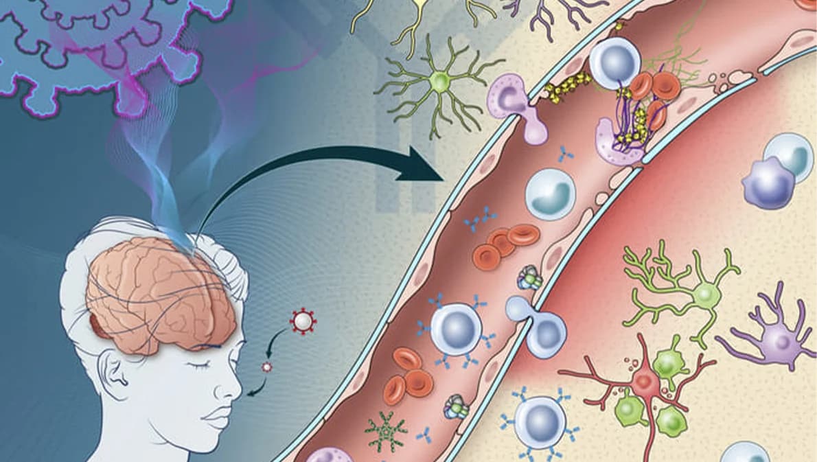 Long COVID จากการติดเชื้อโรคโควิด-19 ทำให้เกิดความผิดปกติของหลอดเลือดในสมอง