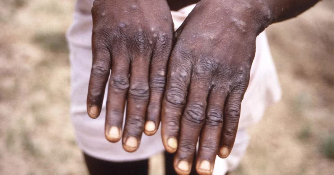 คกก.ด้านวิชาการ พ.ร.บ.โรคติดต่อฯ ยังคงให้ ‘โรคฝีดาษวานร’ เป็นโรคติดต่อที่ต้องเฝ้าระวัง