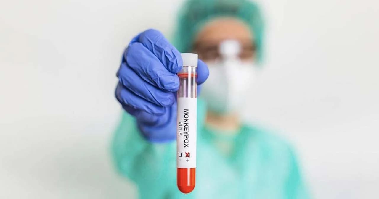 แพทย์ เผย ‘โรคฝีดาษวานร’ ติดจากสัมผัสใกล้ชิด หายได้เองใน 4 สัปดาห์ อาการไม่รุนแรงรักษาตามอาการ