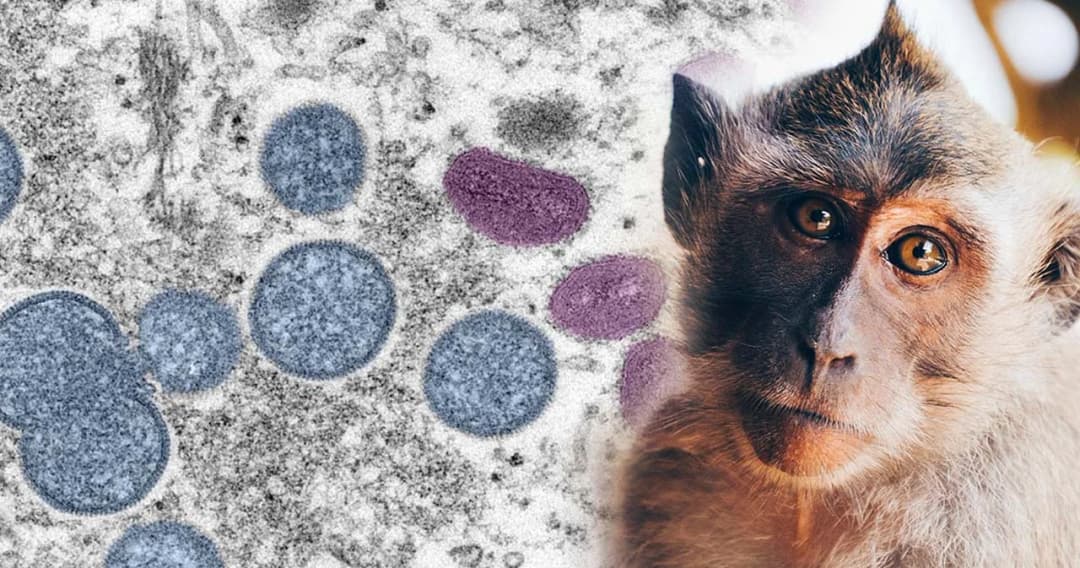 สธ.ติดตามใกล้ชิด ‘ฝีดาษลิง’ ในไทย เผยผู้ป่วย 4 รายอาการไม่รุนแรง แนะงดเพศสัมพันธ์กับคนแปลกหน้า