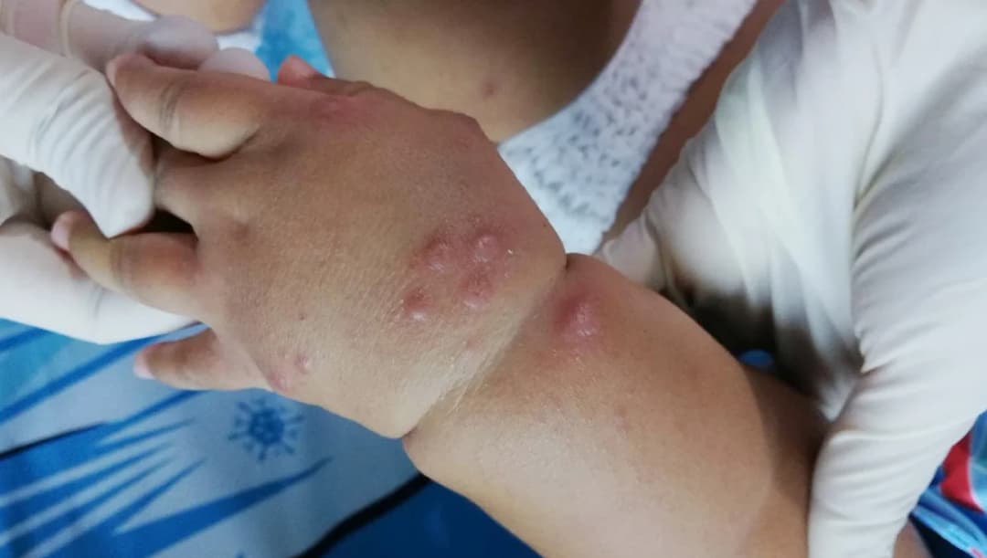 ไทยพบเด็กแรกเกิด – 4 ปี ป่วยโรคมือเท้าปาก กว่า 81% สธ.แนะ 5 วิธีป้องกันการติดเชื้อ